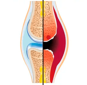 La structure d'une articulation saine et usée avec la désignation de tissu cartilagineux et de liquide synovial.
